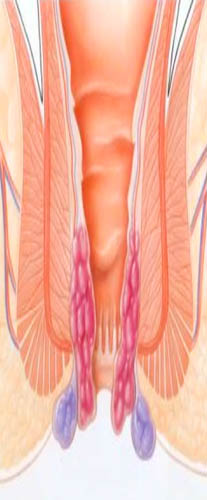 Hemorroides: más frecuentes de lo pensado