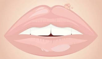 ¡Otra vez el herpes labial!