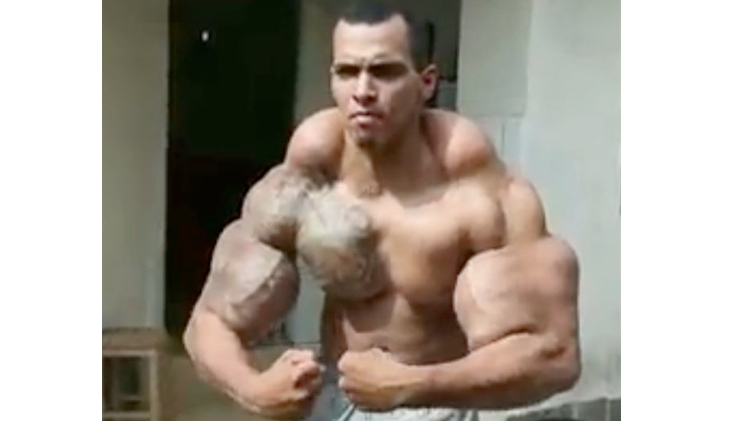 Joven brasileño se inyecta aceite y alcohol para parecerse a Hulk y casi pierde los brazos