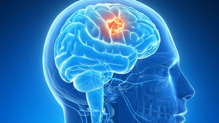 Cómo frenar con un fármaco el crecimiento de tumores cerebrales