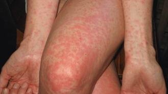 Alergias de verano: menos conocidas pero igual de importantes