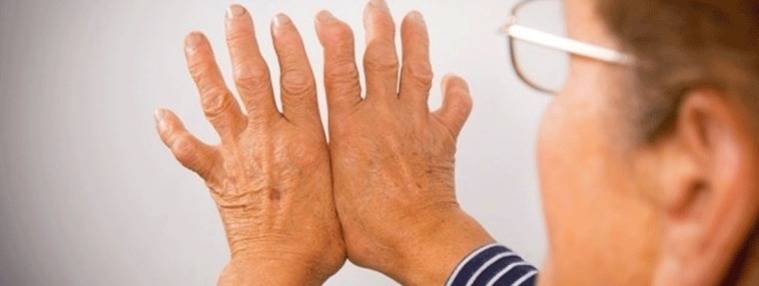 Identifican los primeros pasos hacia la artritis inflamatoria