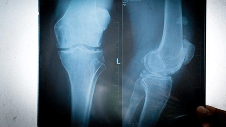 Artrosis de rodilla, ¿cómo evitar el dolor y mantener la movilidad?