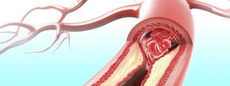 El colesterol `bueno´ también se convierte en malo
