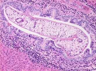 Avances en biomarcadores mejoran diagnóstico de infecciones hepáticas y cáncer biliar