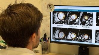 Estudio del Hospital Puerta de Hierro descarta que la hipertrabeculación ventricular izquierda sea una enfermedad cardíaca independiente