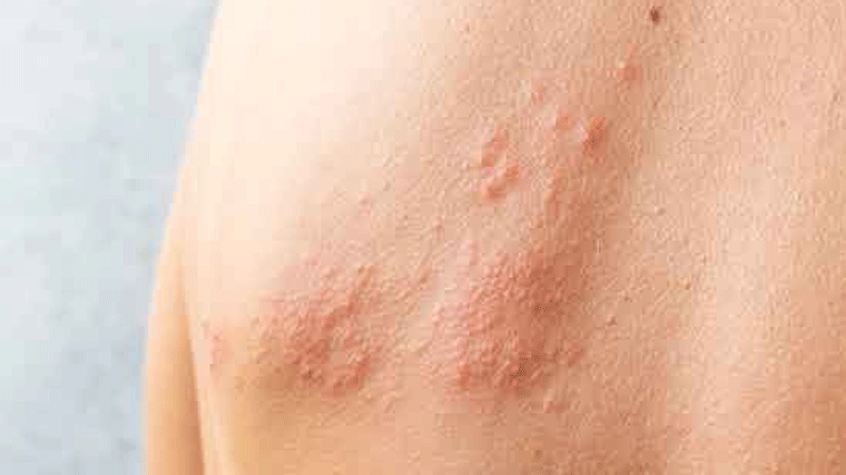 Descubren un nuevo antiviral contra el herpes simple que vence resistencia a tratamientos