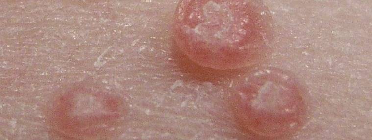 Molusco contagioso, ¿qué es y cómo se transmite?